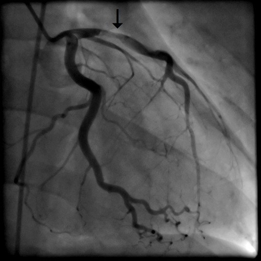 Coronary angiography in RAO view with dissection of the | Open-i