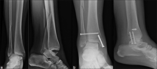 What Is A Bimalleolar Fracture Of The Ankle