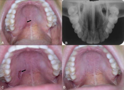 clinical-features-a-submucosal-nodule-on-the-right-si-open-i