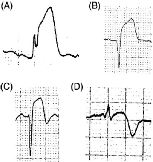 The Ecg Patterns Of The Preinfarction Syndrome And Evol Open I