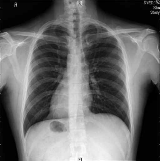 X-ray chest showing dextrocardia and gastric air bubble | Open-i X-ray chest showing dextrocardia and gastric air bubble | Open-i