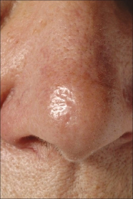 Morphoeic Basal Cell Carcinoma On Nasal Tip Open I