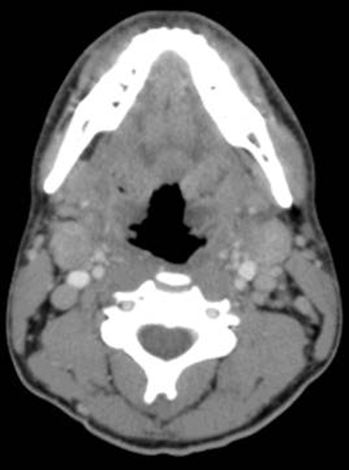 CT scan of head and neck. Note cervical lymphadenopathy | Open-i