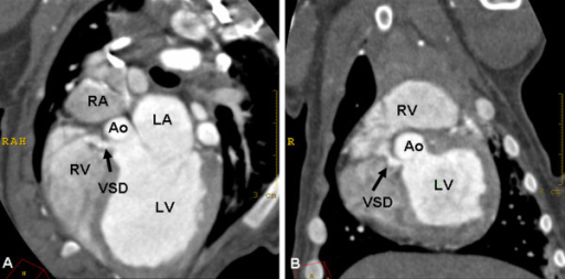 Ventricular septal defect in a dog. Oblique transversal | Open-i