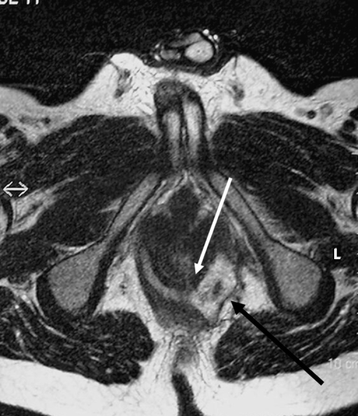 Horseshoe fistula in the intersphincteric plane on an axial T2-weighted ...