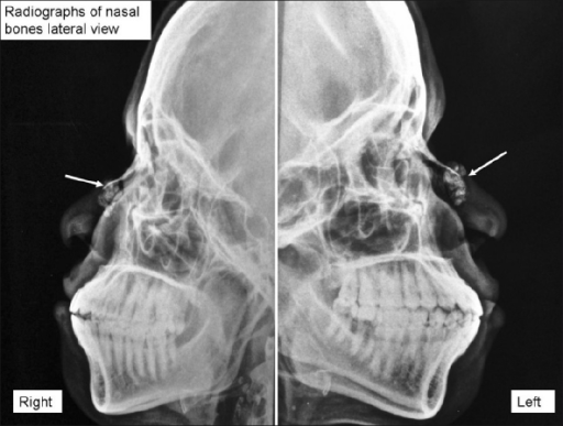 Nasal Bones X Ray Labeled | Sexiz Pix