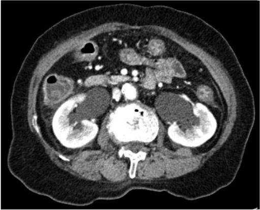 Follow-up CT scan. Note marked bilateral hydronephrosis | Open-i