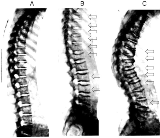 Spine Imaging As Obtained From VFA Software On DXA Scan | Open-i