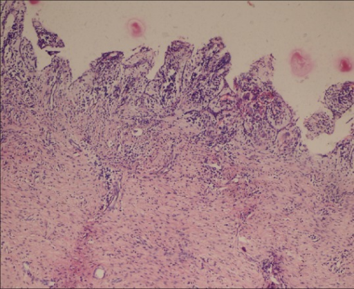 Cystic cavity lined by nonkeratinized stratified squamous