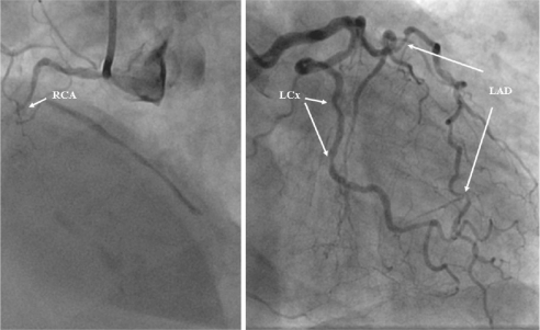 Coronary Angiogram From The Patient With Inferior Suben Open I   PMC2621377 Tcrm 4 705f3 