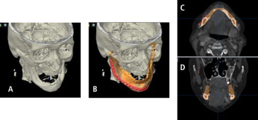nervios mandibular