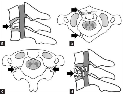 Cervical Spine Injury Types (a) Hyperflexion leading a | Open-i