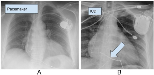 difference-between-pacemaker-and-implantable-cardioverter-defibrillator