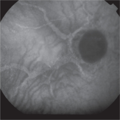 Indocyanine Green Angiography Of Angioid Streaks Please Note The Hyperfluorescent Lines With Pinpoints Indocyanine Green Angiography Of Angioid Streaks Please Note The Hyperfluorescent Lines With Pinpoints