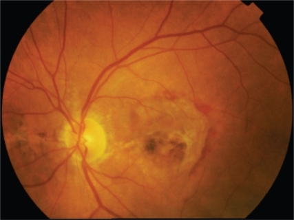 Color Fundus Photograph In An Eye With Angioid Streaks And Choroidal Neovascularization Color Fundus Photograph In An Eye With Angioid Streaks And Choroidal Neovascularization