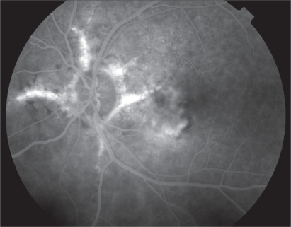 Fluorescein Angiography Of Left Eye With Angioid Streaks Complicated By Choroidal Neovascularization Fluorescein Angiography Of Left Eye With Angioid Streaks Complicated By Choroidal Neovascularization