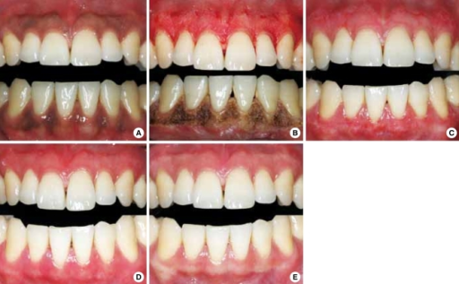 a) Preoperatice photo case 2. (b) Post operative photograph of case 2