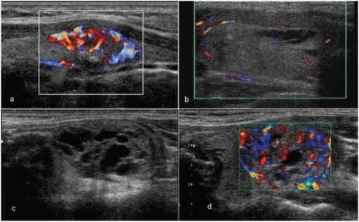 patterns-of-vascularity-in-thyroid-nodules-the-nodule-in-a-with