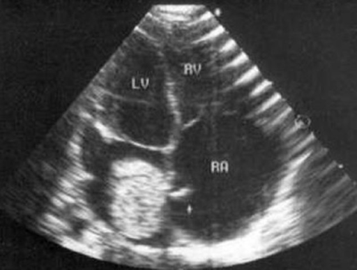 Echocardiographic image of myxoma on the interatrial se | Open-i