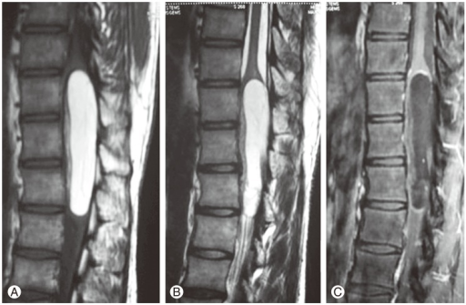 Magnetic resonance imaging scan of dorso-lumbar spine. T2 weighted