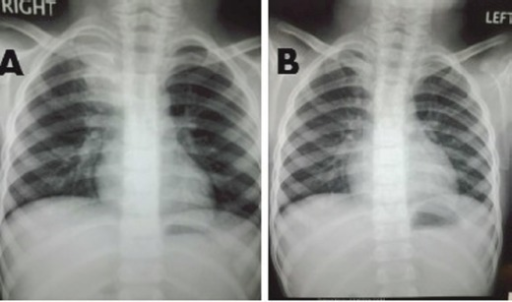 Panel A Chest X ray Showing Inhomogeneous Opacity In The Right Upper panel-a-chest-x-ray-showing-inhomogeneous-opacity-in-the-right-upper