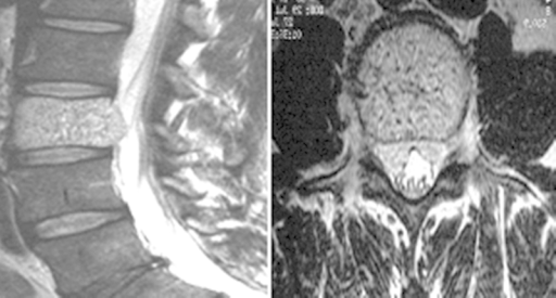 Quotminquot Vertebral Hemangioma Vertebral Angioma Symptoms