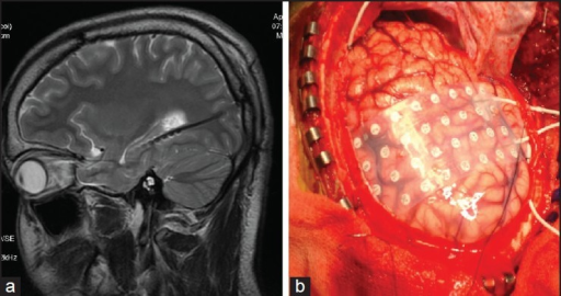 stereo eeg