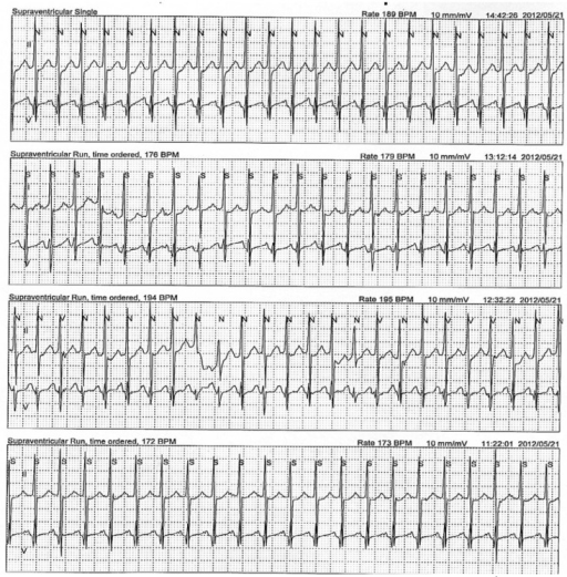 Holter monitoring shows atrial tachycardia (heart rate | Open-i