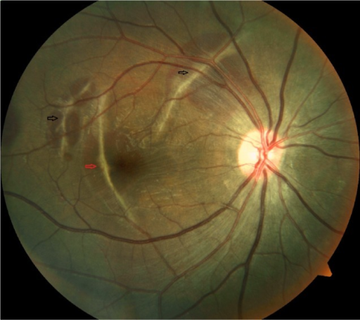 Fundus Photo Right Eye Showing Multiple Indirect Choroi Fundus Photo Right Eye Showing Multiple Indirect Choroi