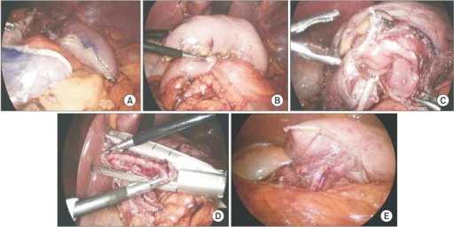 gastroduodenostomia