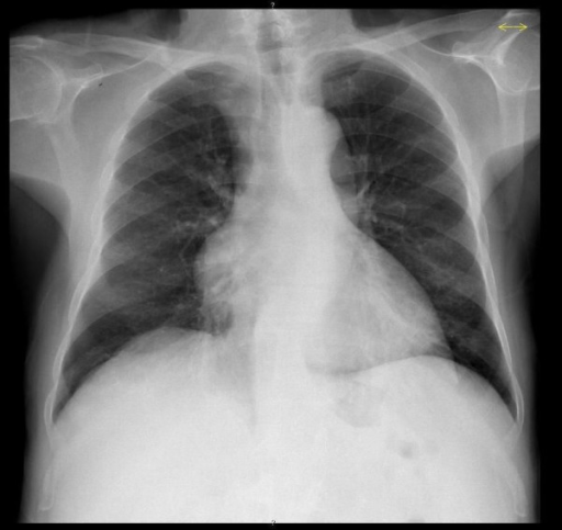 chest X-ray; mediastinal enlargement detected in the in | Open-i