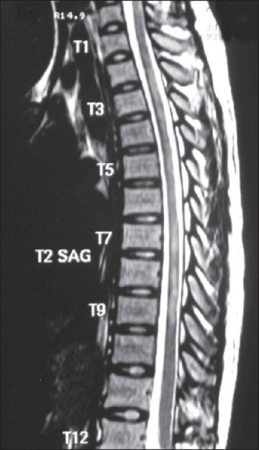 Mri Thoracic Spine Showing T2 Weighted Hyperintense Les Open I