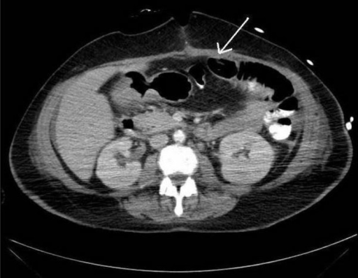 Computed Tomography (CT) of the abdomen showing chylous | Open-i