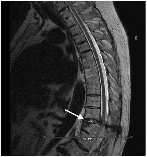 T2 thoracic MRI showing focal signal abnormality at the | Open-i