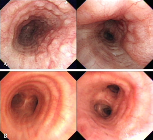 Bronchoscopy performed on admission shows variable-size 