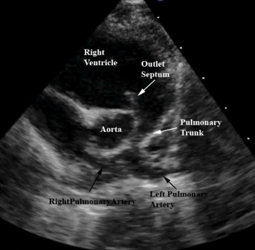 This still frame image of a parasternal short axis view open i