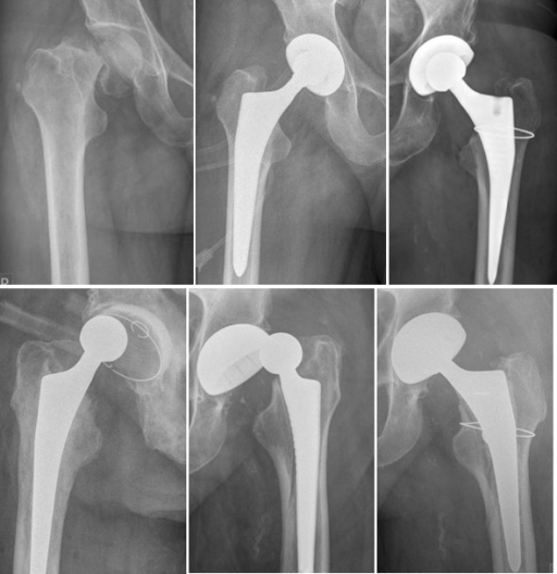 Femoral neck fracture treated with total hip arthroplas