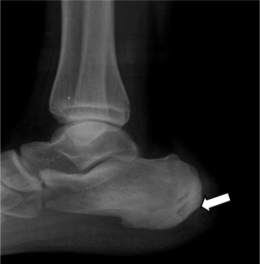 Lateral view of the right ankle shows a small lucent le | Open-i