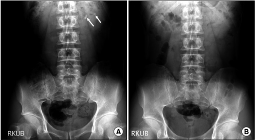 (A) Preoperative Kidney-ureter-bladder (KUB) Abdominal | Open-i