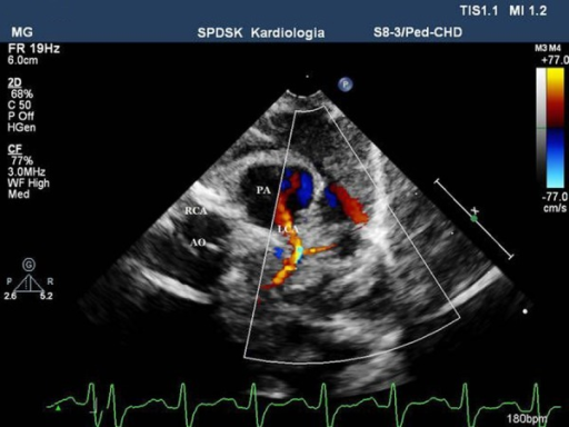 2d-echo-parasternal-short-axis-view-at-the-level-of-th-open-i