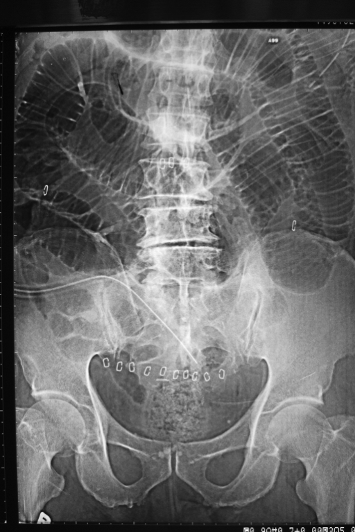 Abdominal x-ray showing small bowel obstruction. | Open-i