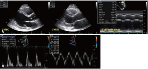 Left Ventricular Systolic Dysfunction