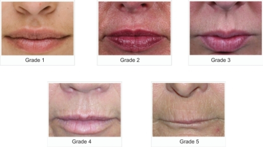 Five-point photonumeric scale used for upper lip atroph | Open-i