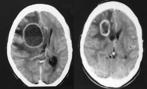 CT scan brain showing large 5×4×4.5 cm abscess in rig | Open-i