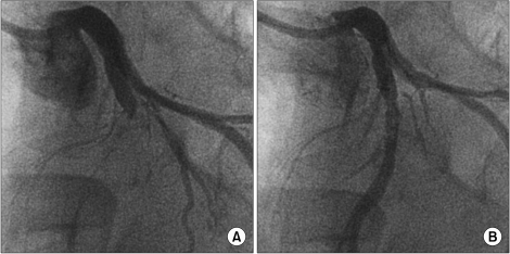 Coronary Angiogram Cag Before And After Percutaneous Open I