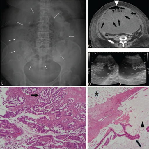 Ct-scan: Burkitt´s lymphoma in the small intestine - DocCheck