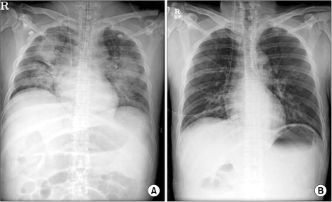 pneumonia cxr findings