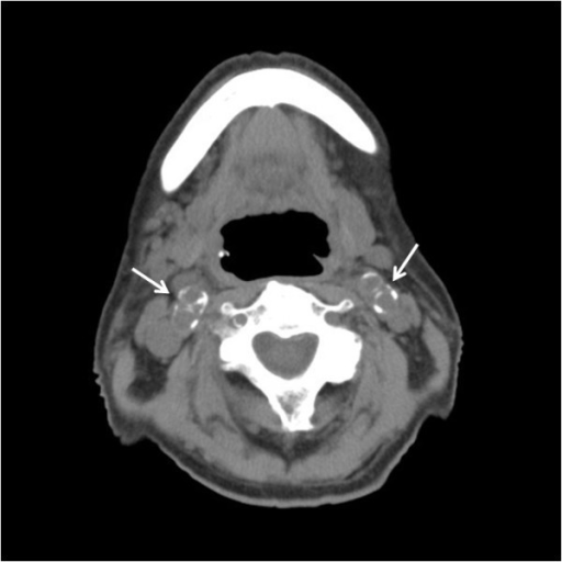 Carotid artery calcification detected by multi-detector | Open-i