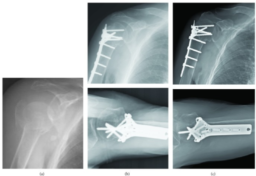 A A 71 Year Old Female Patient Sustained Right Proxim Open I