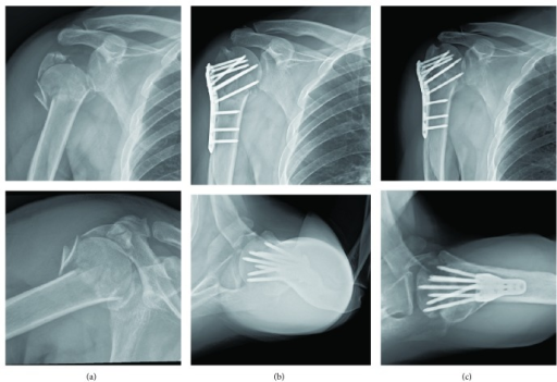 A A 51 Year Old Male Patient Sustained Right Proximal Open I